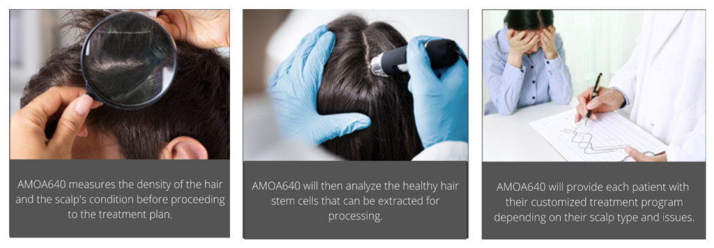 Stem Cell Therapy Scalp Hair Injection Amoa 640